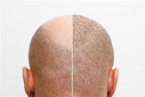 De Beste Nazorg Voor Je Haartransplantatie