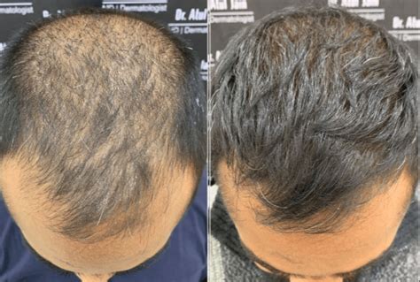 De Invloed Van Leeftijd Op Haartransplantatie