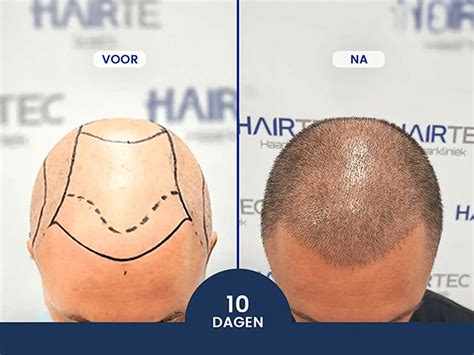 De Populairste Methoden Van Haartransplantatie