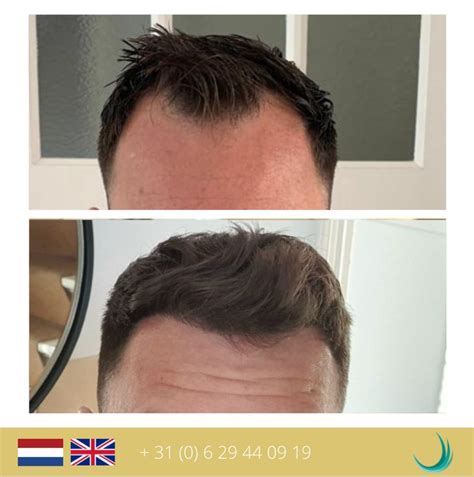 Haartransplantatie DHI: Is Het Geschikt Voor Jou?