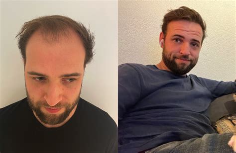 Haartransplantatie Voor En Na: Jouw Reis Naar Volumineus Haar