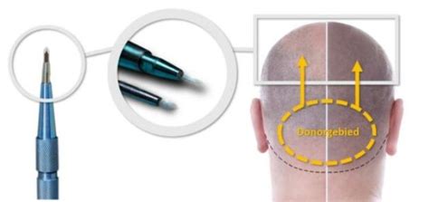 Saffier FUE: De Technologie Achter De Procedure